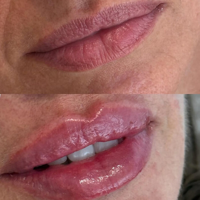 Preenchimento Labial